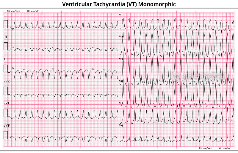 心电图室性心动过速单型- 12导联心电图常见病例- 6秒/导联